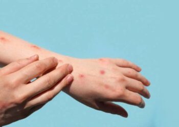 وزارة الصحة تسجل انخفاضا في حالات الإصابة بـ”بوحمرون”